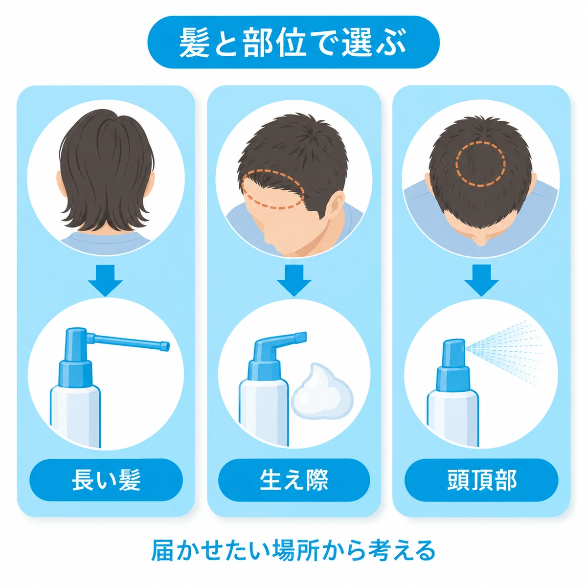 長い髪、生え際、頭頂部に合わせた育毛剤の出口タイプを見比べる図